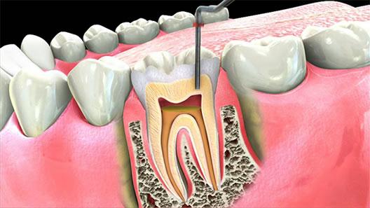 Kanal Tedavisi (Endodonti)